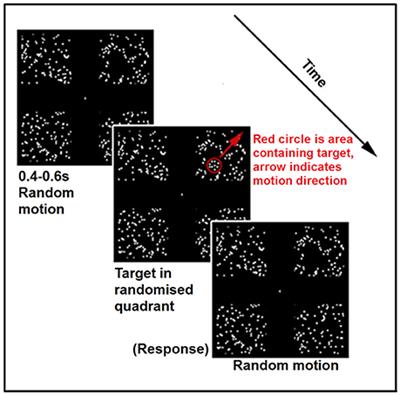 Impaired Activation of Visual Attention Network for Motion Salience Is Accompanied by Reduced Functional Connectivity between Frontal Eye Fields and Visual Cortex in Strabismic Amblyopia